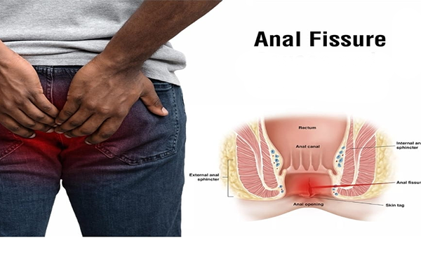 Fissure / फिशर उपचार