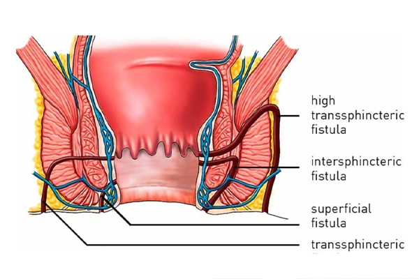 Fistula / भगंदर उपचार