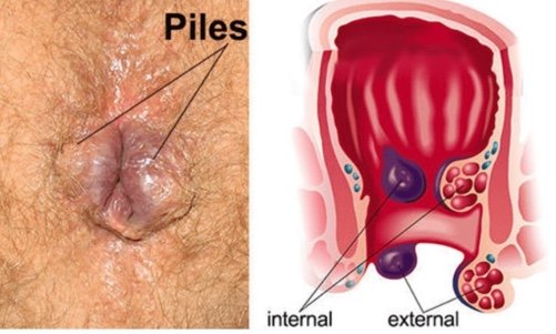 आंतरिक बवासीर (Internal Hemorrhoids)
