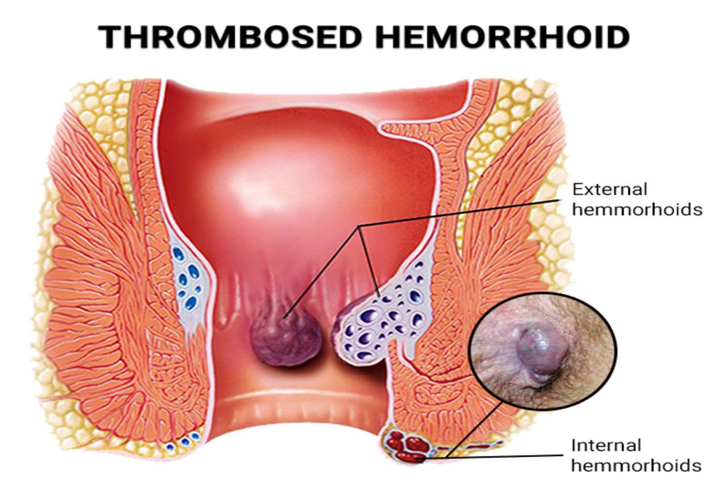 थ्रोम्बोज्ड बवासीर (Thrombosed Hemorrhoids)