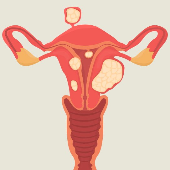 PCOD PCOS Ovarian Cyst Hindi