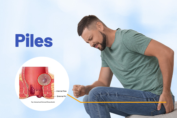 Piles / बवासीर उपचार