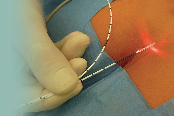 Pilonidal Sinus उपचार