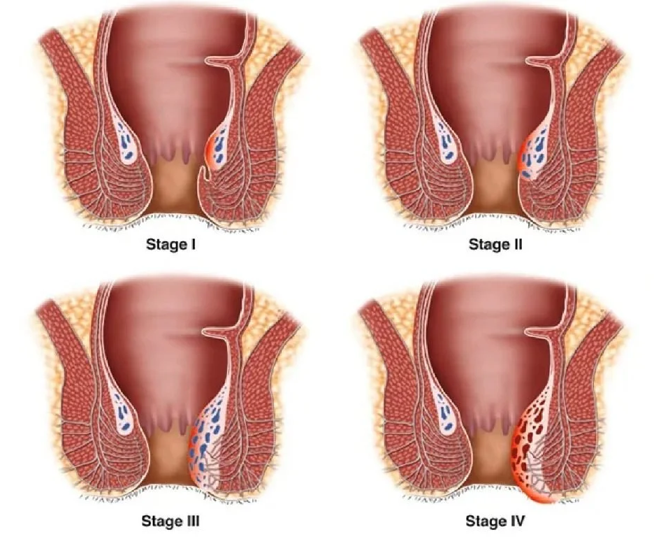 Stages of Piles - बवासीर की अवस्थाएं
